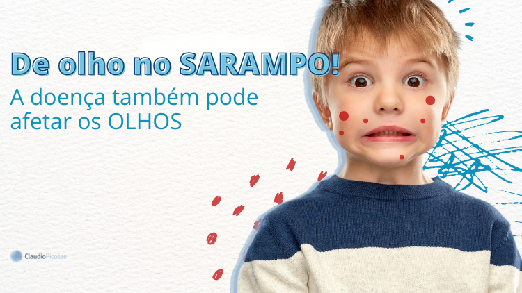  De olho no SARAMPO! A doença também pode afetar os OLHOS