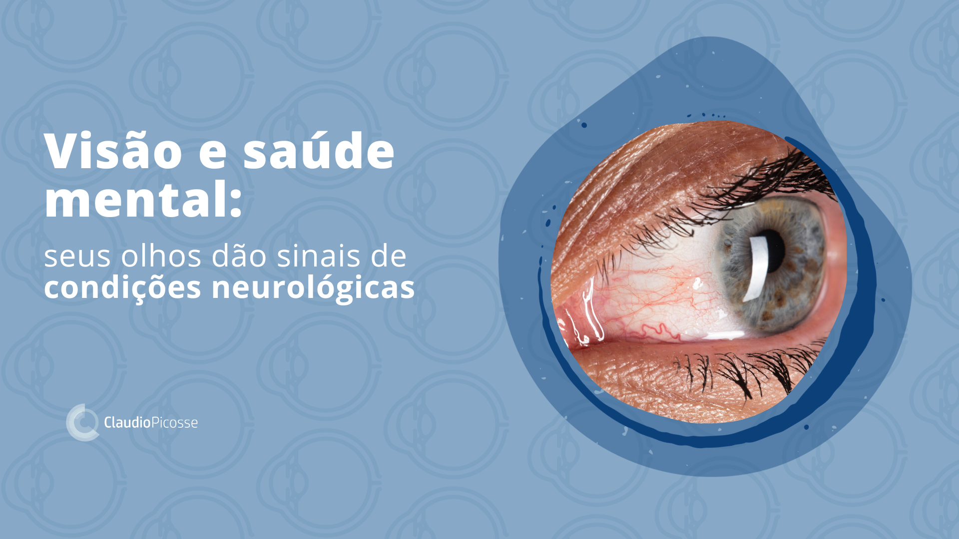 Considerações gerais sobre doenças da retina - Distúrbios