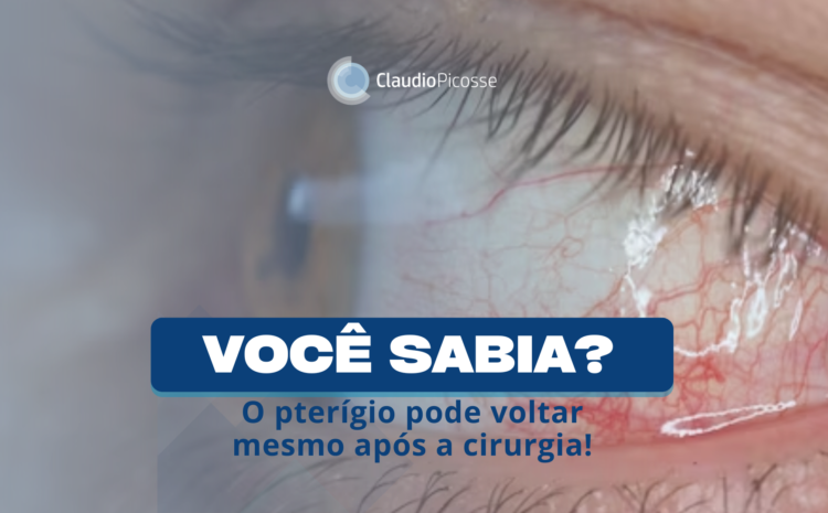  Você sabia? O pterígio pode voltar mesmo após a cirurgia!